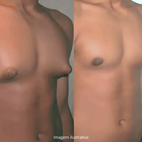 Cirurgião Estética Avançada Clínica Ginecomastia, aumento das mamas, aumento peitoral, São Paulo SP